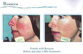 Chicago Laser Rosacea Treatment